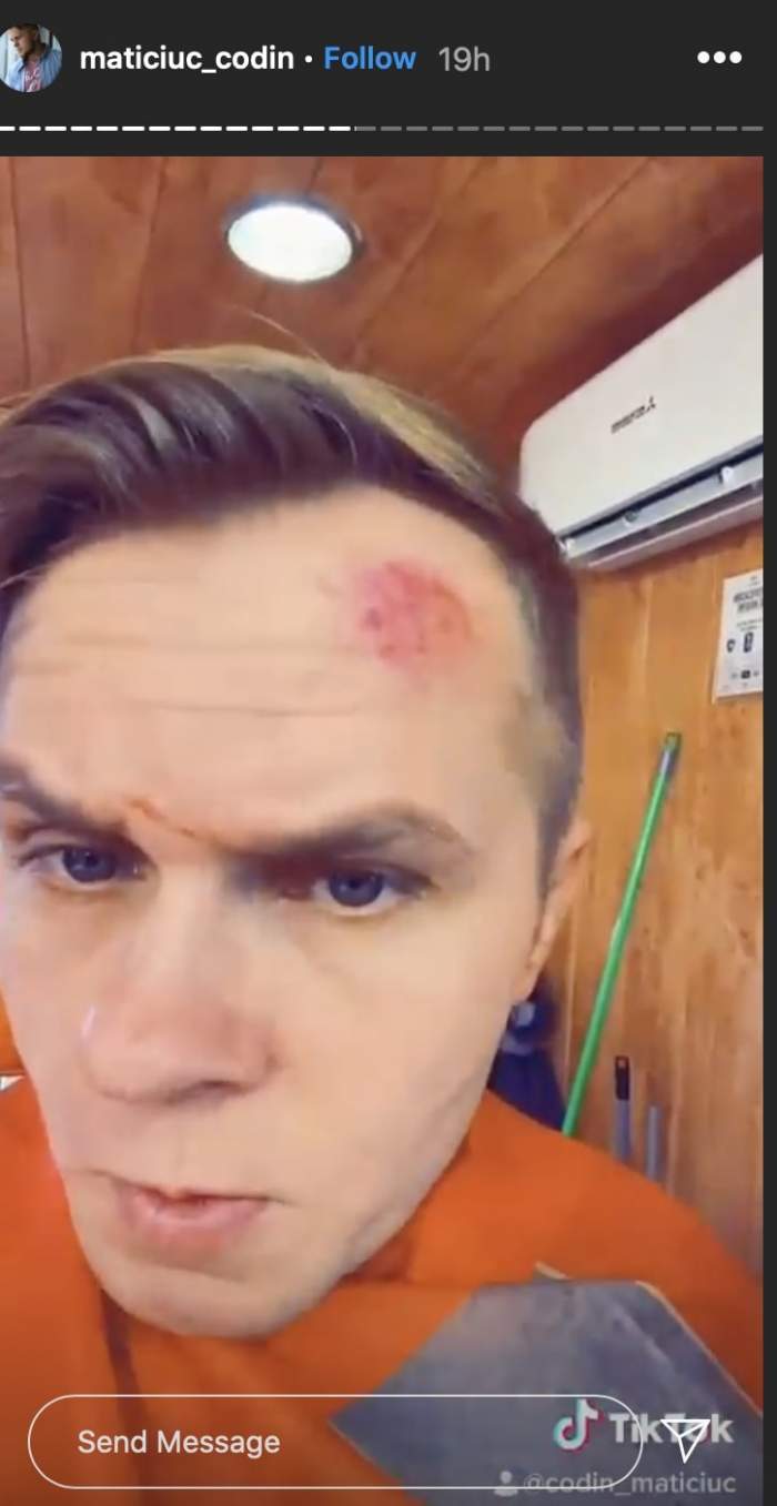 Codin Maticiuc are fața plină de vânătăi. Imaginile au îngrozit pe toată lumea