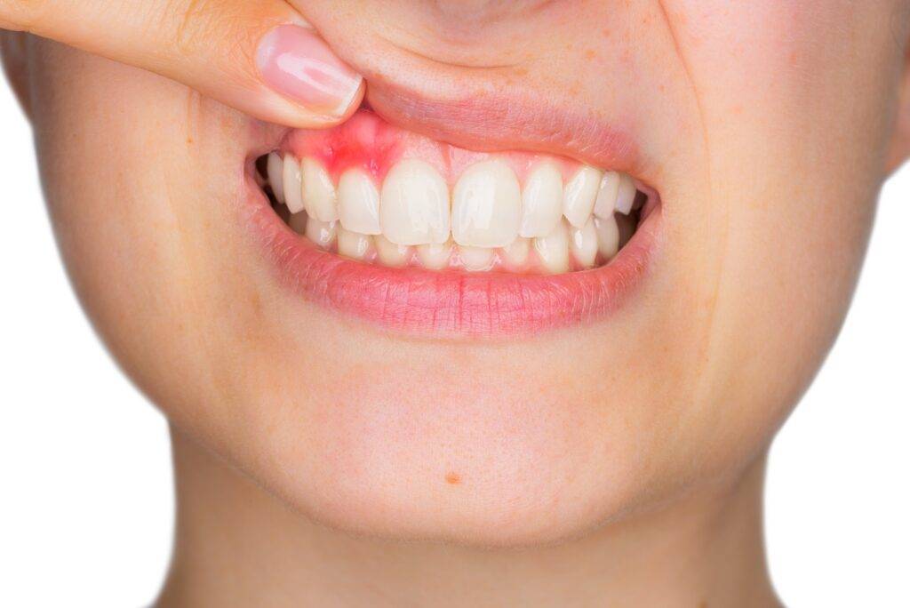 Cum recunoaștem o infecție dentară și cum o putem trata cât mai rapid?