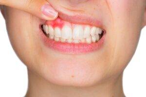 Cum recunoaștem o infecție dentară și cum o putem trata cât mai rapid?